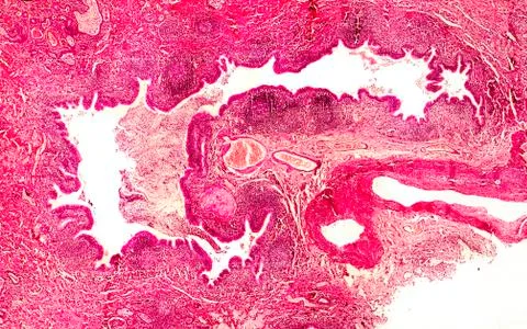 Bronchiectasis, light photomicrograph Stock Illustration
