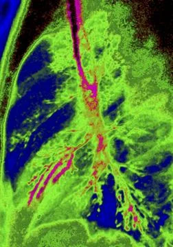  Bronchiectasis, x-ray Bronchiectasia (bronchial dilatation), pulmonary x-... 库存照片