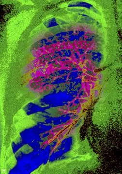  Bronchiectasis, x-ray Bronchiectasia (bronchial dilatation), pulmonary x-... 库存照片