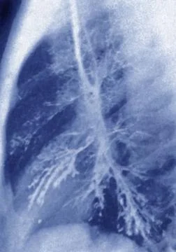  Bronchiectasis, x-ray Bronchiectasia (bronchial dilatation), pulmonary x-... 库存照片