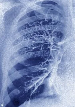  Bronchiectasis, x-ray Bronchiectasia (bronchial dilatation), pulmonary x-... 库存照片
