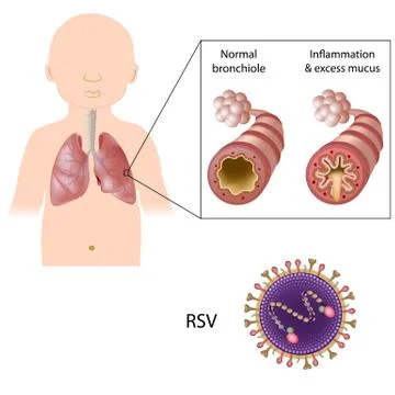 Bronchiolitis caused by rsv 스톡 일러스트
