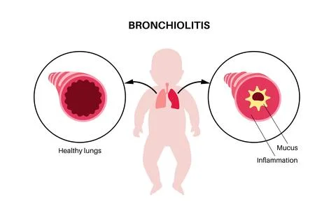 Bronchiolitis lung disease Stock Illustration