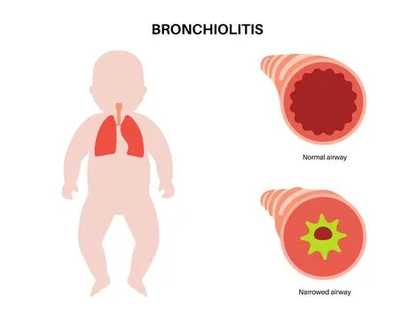 Bronchiolitis lung disease Stock Illustration
