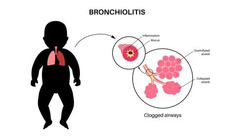 Bronchiolitis lung disease Stock Illustration
