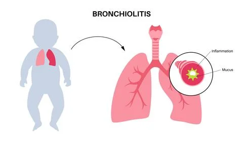 Bronchiolitis lung disease Stock Illustration