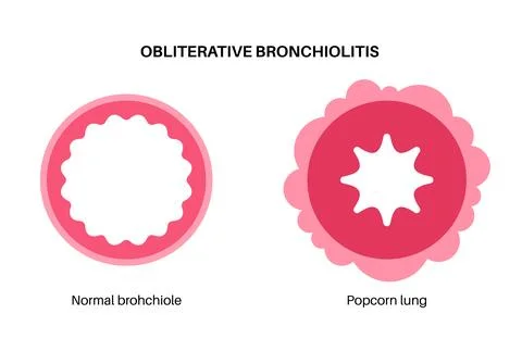 Bronchiolitis lung disease Stock Illustration