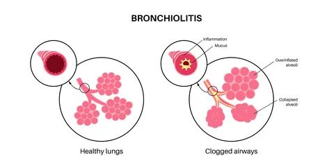 Bronchiolitis lung disease Stock Illustration