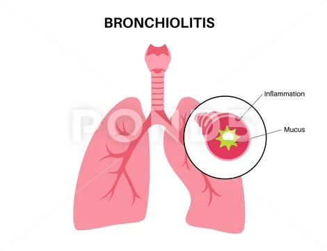 Bronchiolitis lung disease ~ Clip Art ~ Download #238491547