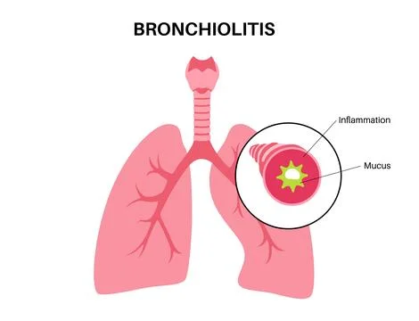 Bronchiolitis lung disease Stock Illustration