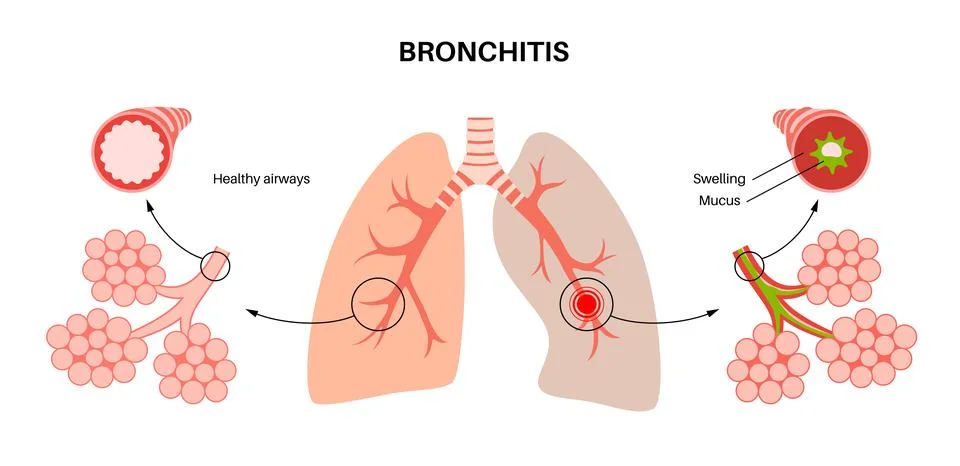 Bronchitis lung disease Stock Illustration