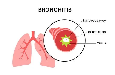 Bronchitis lung disease Stock Illustration