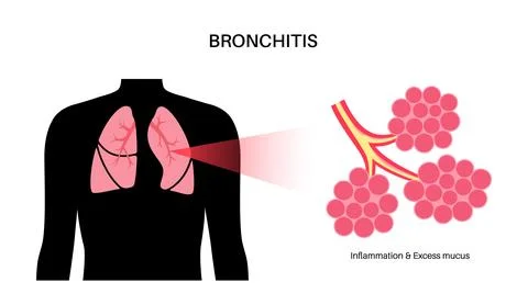 Bronchitis lung disease Stock Illustration