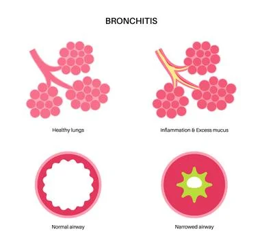 Bronchitis lung disease Stock Illustration