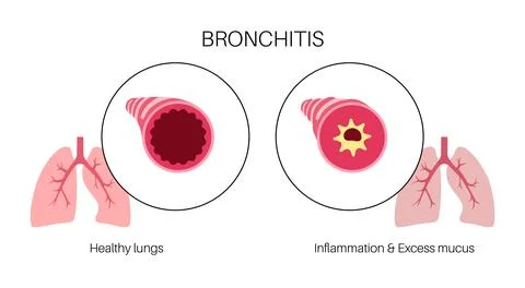 Bronchitis lung disease Stock Illustration