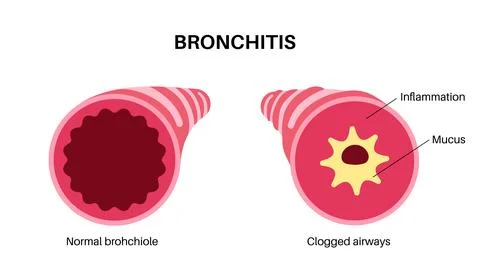 Bronchitis lung disease Stock Illustration