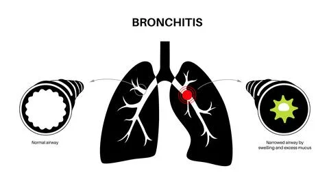 Bronchitis lung disease Stock Illustration