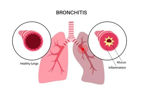Bronchitis lung disease Stock Illustration