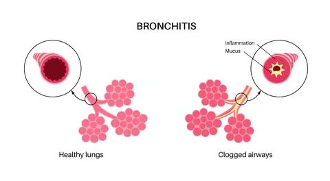 Bronchitis lung disease Stock Illustration