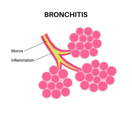 Bronchitis lung disease Stock Illustration
