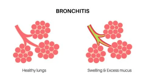 Bronchitis lung disease Stock Illustration