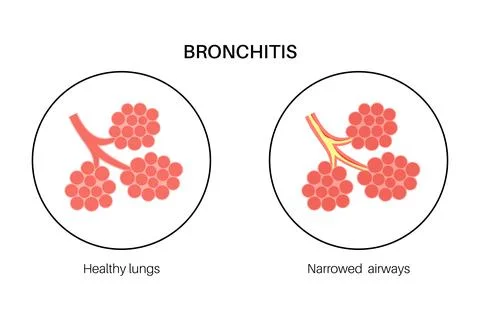 Bronchitis lung disease Stock Illustration