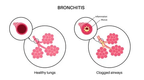 Bronchitis lung disease Stock Illustration