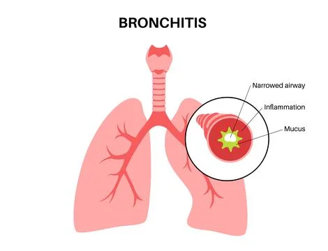 Bronchitis lung disease Stock Illustration