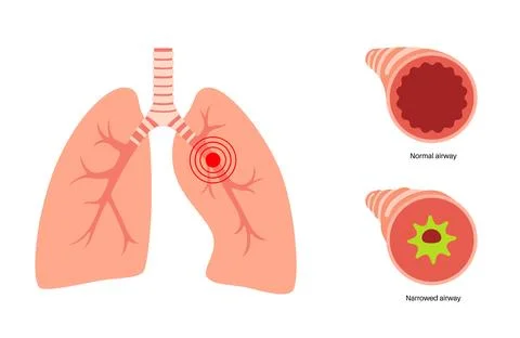 Bronchitis lung disease Stock Illustration