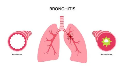 Bronchitis lung disease Stock Illustration