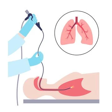 Bronchoscopy procedure concept Stock Illustration