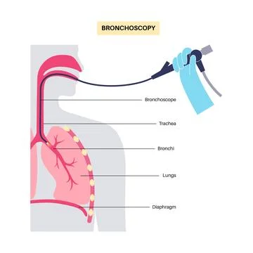 Bronchoscopy procedure concept Stock Illustration