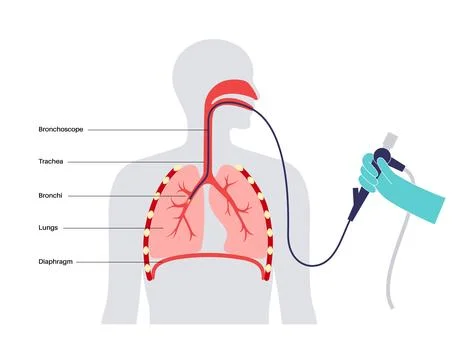 Bronchoscopy procedure concept Stock Illustration