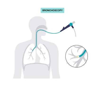 Bronchoscopy procedure concept Stock Illustration