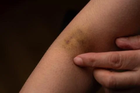 A bruise after an injection 库存照片