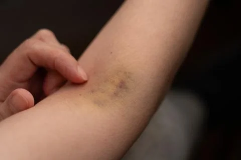 A bruise after an injection 스톡 사진