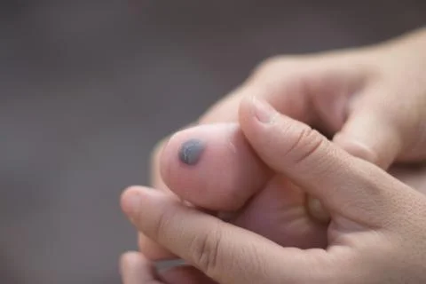Bruise on big toe Stock Photos