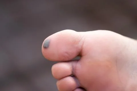 Bruise on big toe Stock Photos
