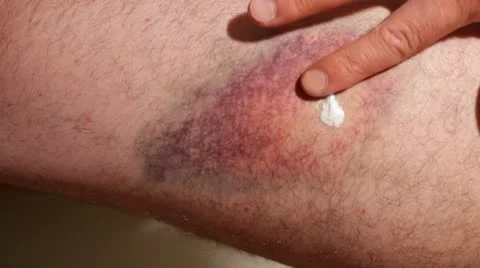 Bruise Stock Footage 10789493