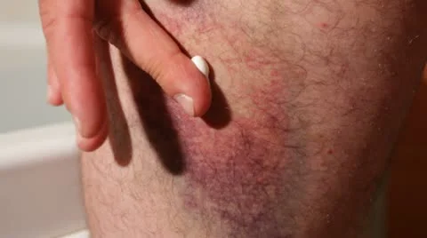 Bruise Stock Footage 10789498