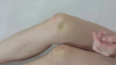 Bruise Stock Footage 119995393
