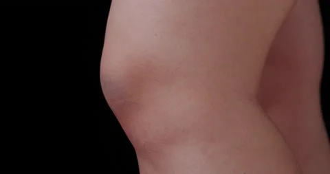 Bruise on the girl's knee Stock Footage 140497724