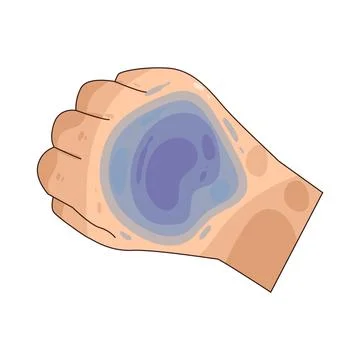 Bruise illustration Stock Illustration