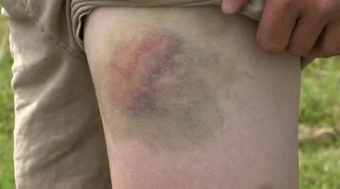 Bruise on Knee Stock Footage 21035998