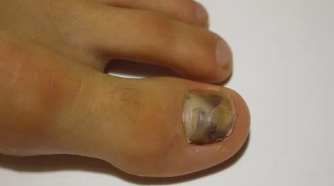A bruise on the nail Vídeo Stock 56536912