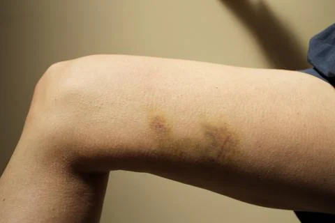 Bruise Stock Photos