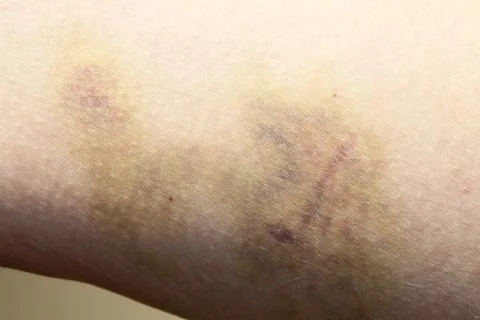 Bruise Stock Photos