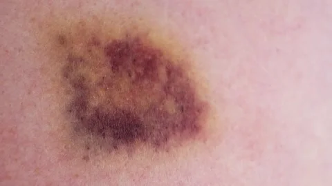 The bruise on skin close-up view. Various shades of healing process. Dark purple Stock Footage 318841870