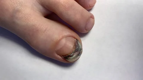 Bruised big toe with darkened nail plate 動画素材 314745091