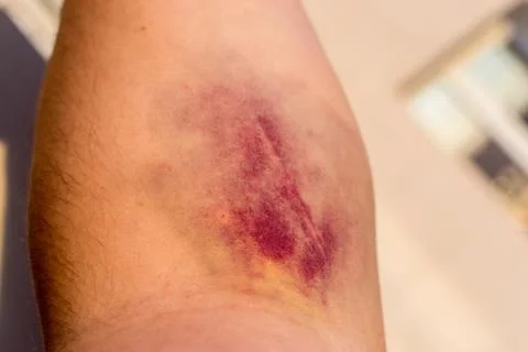 Bruised Man's Forearm Stock Photos